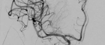 Neuroradiologie erfolgreiche Thrombektomie (medbo | Isabel Wiesinger)