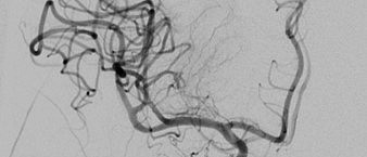 Neuroradiologie erfolgreiche Thrombektomie (medbo | Isabel Wiesinger)