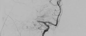 Neuroradiologie_Thrombus_vorher (medbo | Isabel Wiesinger)